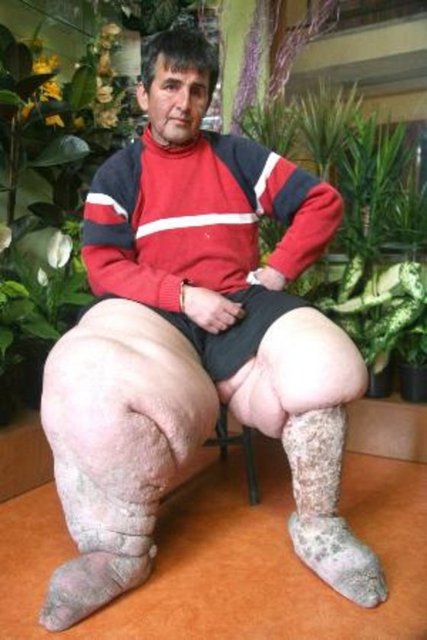 Bu hastalığa Wuchereria bancrofti, Brugia malayi ve B. Timori gibi tümü sivrisinekler tarafından taşınan parazitik kurtlar neden olur.