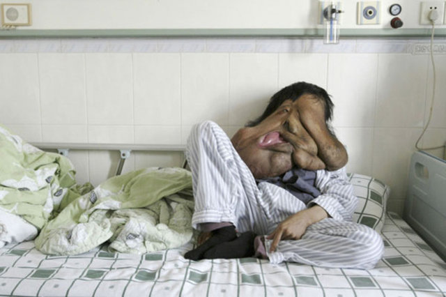 Hastalığın kişinin aile genlerinden aldığı bozukluk ile doğumundan itibaren mutasyona uğrayan genlerden dolayı hastalığın bu şekilde büyüyüp geliştiği açıklandı. -