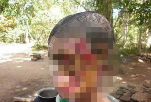 Yüzünün yarısı tamamen etsiz bir iskelet haline gelen kadın dışarıya bile çıkamıyor.