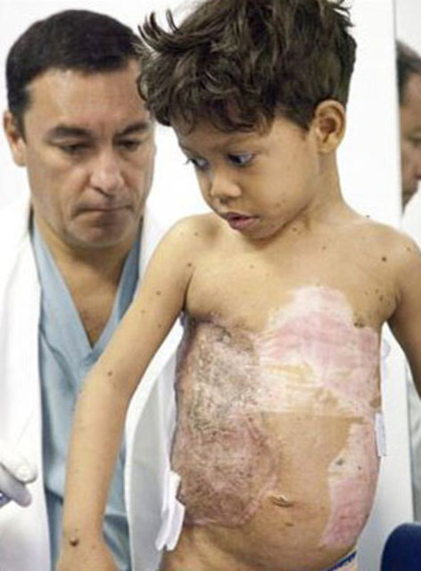 Fakat 3 yıl önce hayatını değiştirecek sırtındaki ağırlığının yüzde yirmisi kadar olan bu büyük yükten kurtulmak için bir ameliyat geçirdi... -