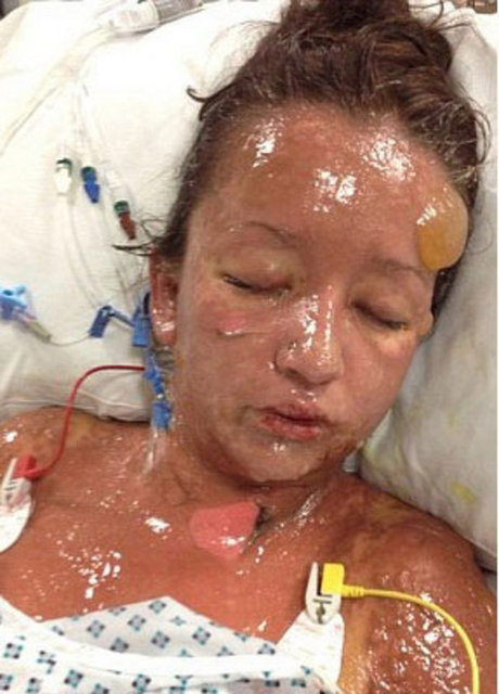 İngiltere'de Leanne Howes adlı genç kızın aldığı mide ilacı cildinde öyle bir alerjik reaksiyona neden oldu ki, kızın bütün hayatı karardı.