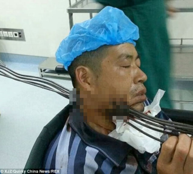 Xie Mo adlı işçi, kent dışındaki bir köprü inşaatında soğuk demir bükme makinesinde çalışırken makine bir anda arızalanarak içindeki demir çubukları büyük bir hızla fırlattı.