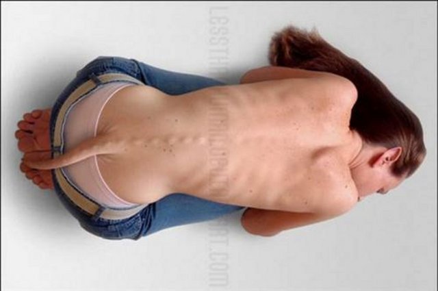 Bu Hastalıkları ilk defa duyacaksınız - Dünyada son derece nadir olarak görülen bir hastalık sonucu kuyrukla dünyaya gelenler arasında ünlü bir şarkıcının olduğu öğrenildi.