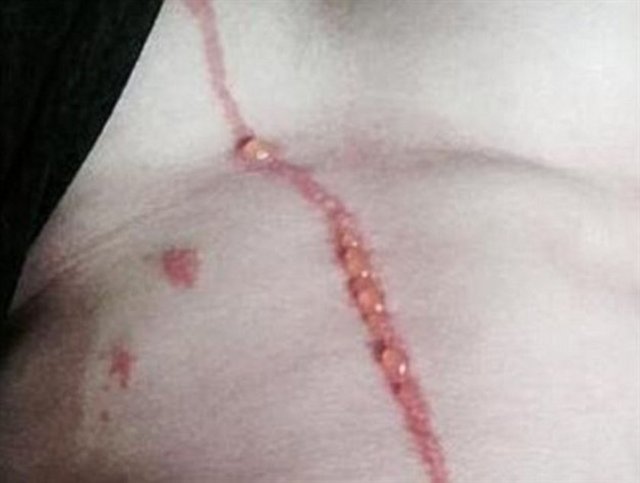 Hemen sağlık merkezine giden genç adama doktorlar, bir böcek ısırığına alerjik reaksiyon gösterdiğini söyleyip bir antihistamin krem vererek taburcu ettiler.