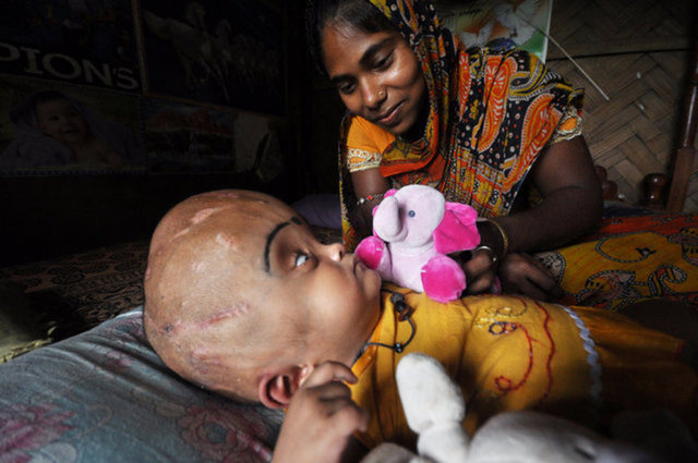 Çocuğun normal boyuttan üç kat daha büyük olan kafasının çevresi ameliyattan sonra 37den 23 santimetreye indirildi