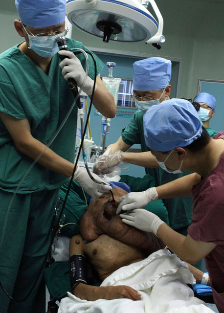 Geçtigimiz günlerde ameliyat Çin'in Guangzhou Hastanesi'nde ameliyat olan adamın sadece sol yanağından 1.5 kilogramı aşkın tümörü alındı.