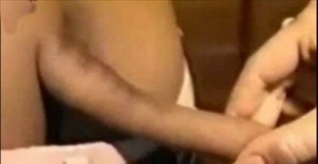 Modern tıpta meningocele adı verilen hastalık, derinin altına gizlenmiş olan, üç ya da dört omurun kaynaşmasıyla ortaya çıkıyor. -