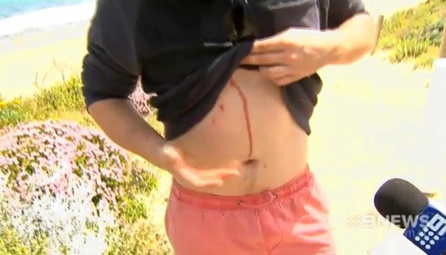 Tropik bir örümcek, kısa bir süre önce apandisti alınan Dylan'ın dikişlerinden derisinin altına girmiş ve iki gündür orada yaşıyordu. Cildinin hemen altına yerleşen bir  örümcek orada ilerliyordu.