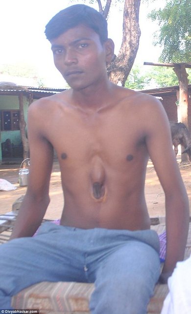 Hindistan'da yaşayan 18 yaşındaki Arpit Gohil'in doğuştan gelen bir rahatsızlığı var. Kalbi, göğüs kafesinin dışında atıyor.