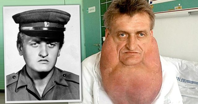 Yüzünde oluşan ve nadir görülen Madelung hastalığına yakalanan Stefan Zoleik'in yüzü tamamen yağ tümörleriyle kaplandı...