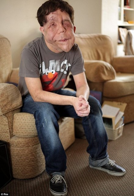 Scarlett Johansson ile Under The Skin filminde oynayan Adam Pearson filmden sonra kendini çapkın bir James Bond gibi hissettiğini söylüyor.