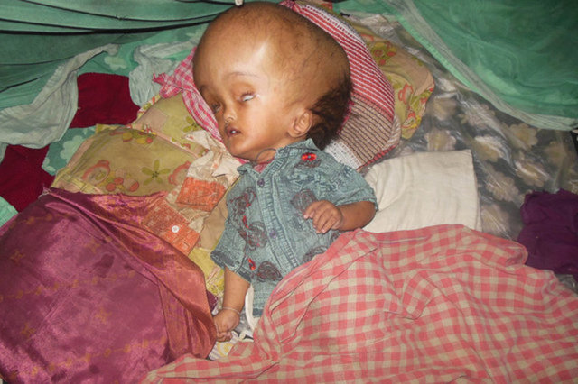 Fatima Khatun, "Roona da bir gün normal çocuklar gibi ayakta durup konuşursa ve bir gün okula gidebilirse çok mutlu olurum." dedi