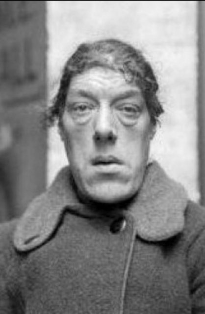 Bu sendrom vücudun bir kısmında olağanüstü büyümelere yol açıyordu. Bevan'ın başı kontrolsüz büyümeye başladı.