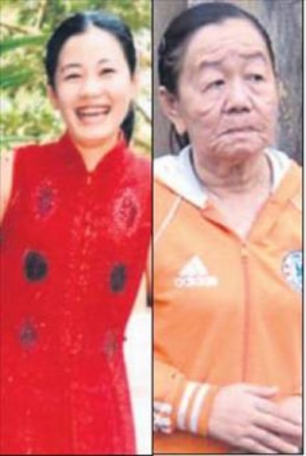 26 yaşındaki Vietnamlı Nguyen Thi Phuong, bir deniz ürününe gösterdiği alerjik reaksiyondan sonra 50 yaş yaşlandı.