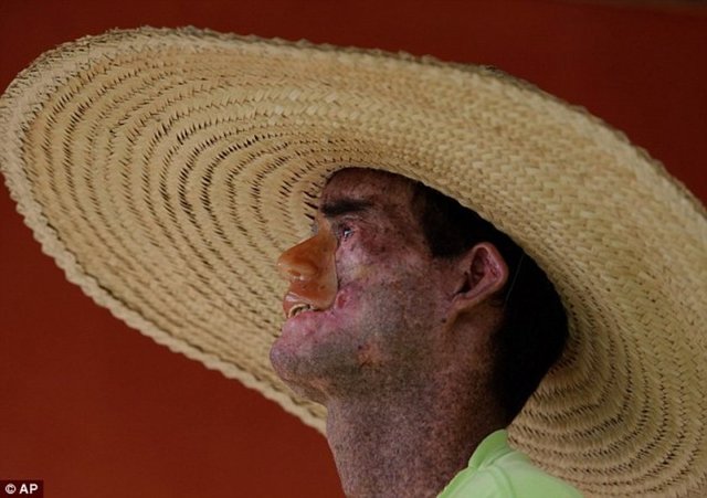 Brezilya'nın Araras kentinde yaşayanların cildi güneş ışınlarına maruz kaldığında eriyor.