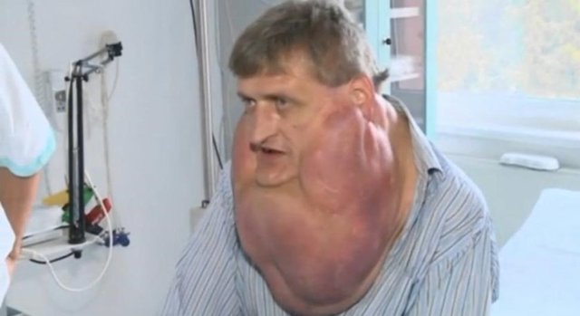 Çok başarılı bir operasyonla Zoleik tümörden kurtuldu" dedi. Zoleik, 10 yıldır yüzünde büyüyen tümörü aldırdığında dünyaya yeniden geldiğini ifade etti...