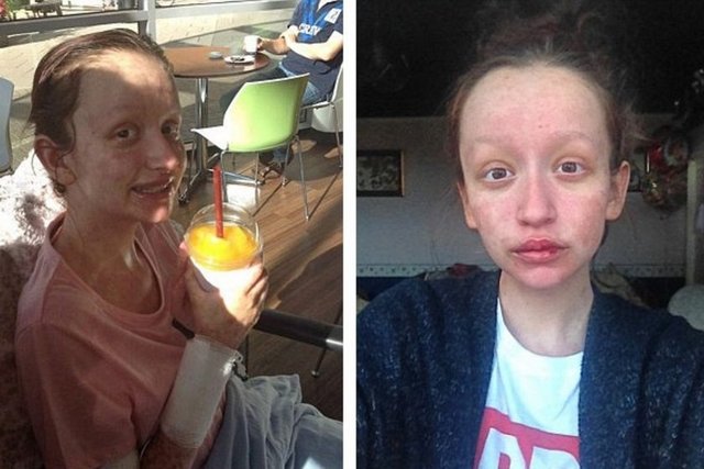 Uzmanların yüzde 10 oranında hayatta kalma şansı verdiği 17 yaşındaki genç kızın yaşaması tam bir mucize