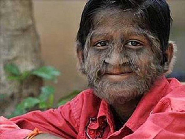 2 yaşındaki Abys DeJesus'ın yüzünde koyu kıllar çıktığında, doktor durumunun Kurtadam Sendromu olarak bilinen şey olduğunu söylemişti.