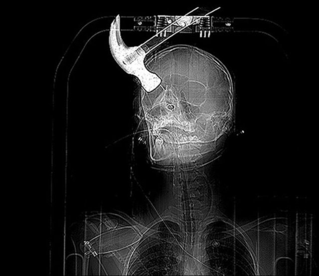 21 yaşındaki Joseph Williams ev arkadaşı Connor Huntley onu kızdırınca başına çekiçle vurdu.