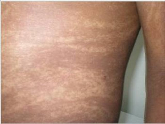 Blaschko çizgileri oldukça nadir görülür ve ilk olarak 1901′de Alman dermatolojist Alfred Blaschko tarafından sunulan açıklanamaz bir insan anatomisi fenomenidir.