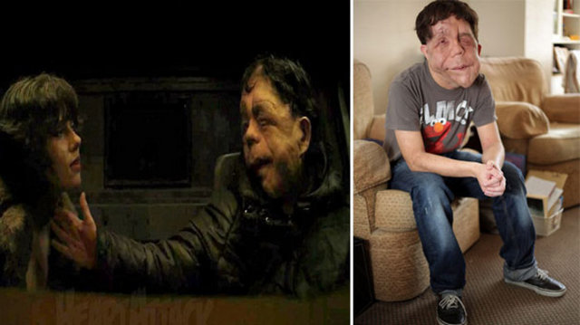 Hastalığı şansı oldu - "Nörofibromatoz" yani deri ve sinirlerde görülen doku bozukluklarının yol açtığı bir cilt hastalığı…