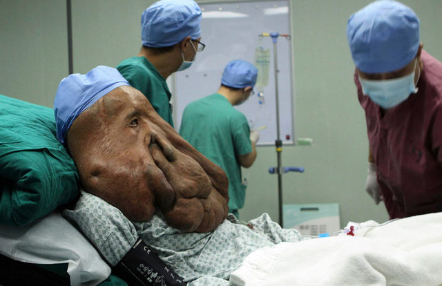 Sinir sistemindeki genetik rahatsızlık nedeniyle yüzünde oluşan tümörle yaşayan Çinli adam bir dram yaşıyor.  Çin'in Hunan eyaletinden yaşayan  37 yaşındaki Huang Chuncai, dünyanın en büyük yüz tümörüne sahip hastası.