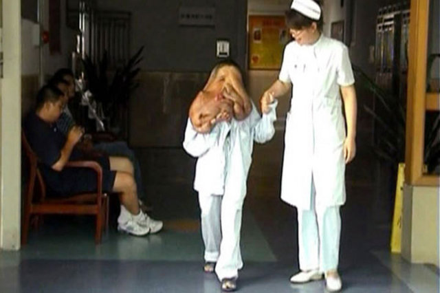 Huang Chuncai'nin suratındaki tümörün 5 sene önce tartıldığında 15 kilogram olduğu ve suratındaki ekstra ağırlık nedeni ile omurganın ve beldeki kasların zedelendiği de belirlendi.