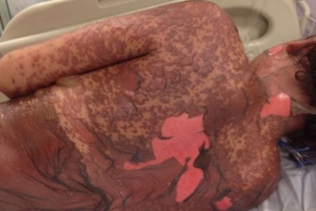 Yaşadığı kabustan sonra hayata yeniden dönen Leanne Howes, mide ilacı aldıktan çok kısa bir süre sonra cildinde reaksiyonları hissetti.