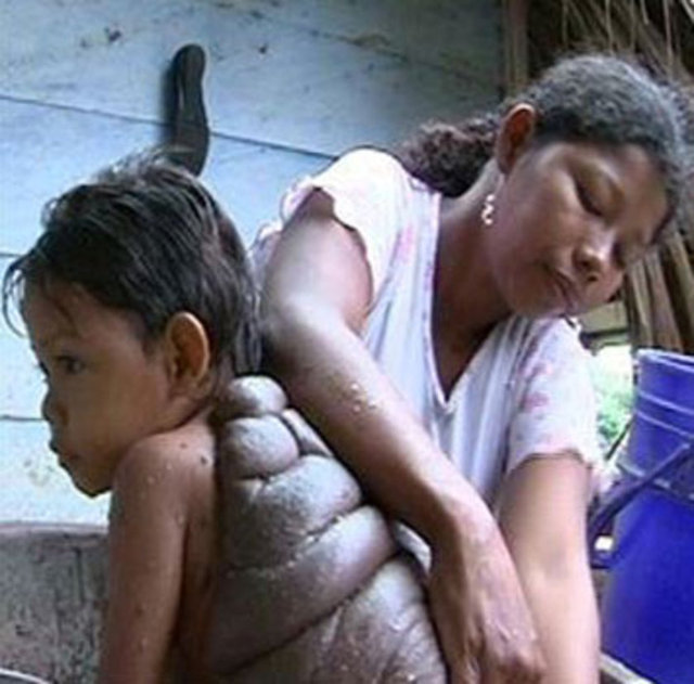 İngiliz plastik cerrahı Neil Bulstrode , Didier'in bu durumunu duyduktan sonra onu bu kaplumbağa sırtından kurtaracağına ve onunda diğer çocuklar gibi olacağına dair söz verdi...