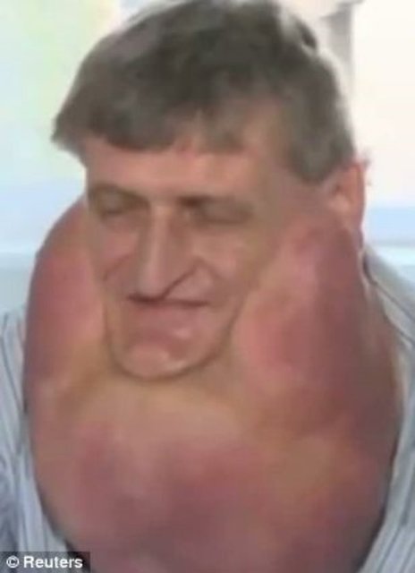 Ameliyat sonrası haline inanamadığını söyleyen Zoleik...