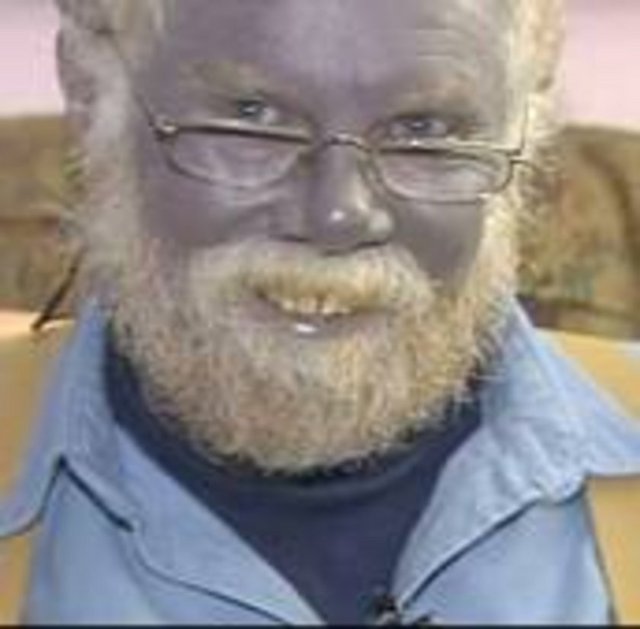 Bu özellik nesilden nesile aktarılmıştır. Bu durumdaki insanlar mavi, erik moru, çivit mavisi yada hemen hemen mora yakın tene sahiptirler.