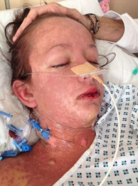 Tüm cildinde korkunç yaralar çıkan genç kızın kaş kirpik, saç ve hatta tırnakları bile döküldü.