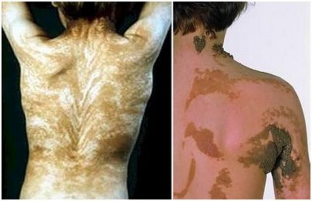 Blaschko Çizgileri: Tüm vücuttaki ilginç çizgiler