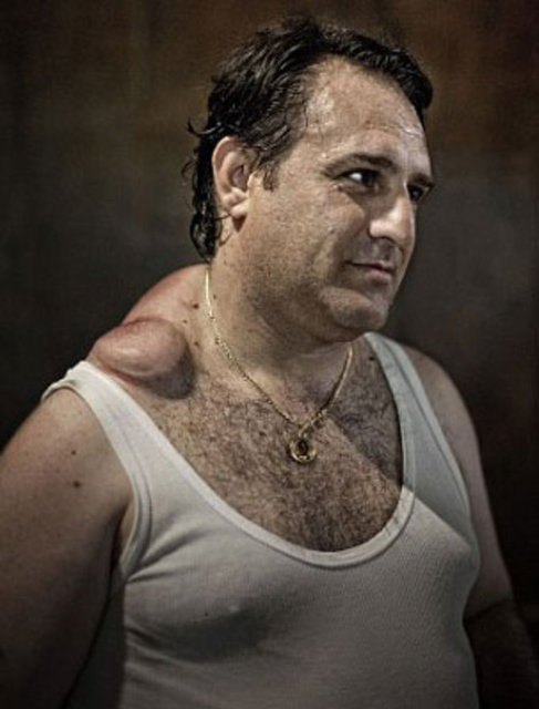 BU HASTALIK ONLAR İÇİN GURUR -  - Tam bin 600 yıldır bu hastalık, kimine göre ise birer kahramanlık madalyası.