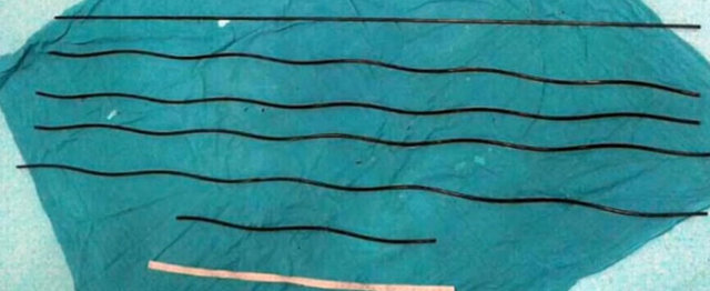 Demir çubuklardan altısı Xie Mo'nun boğazına ve nefes borusuna saplandı. - İşçi boğazına saplanan demirlere rağmen sağ kalmayı başardı ve kaldırıldığı hastanede demirler 5 saat süren bir operasyonla çıkarıldı.