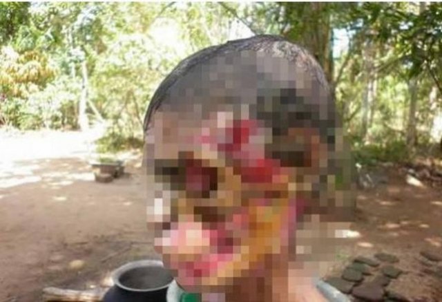 Ameliyata alınan kadının yüzünün virüslü et kısımları alındı ama yapılan bütün tedavilere rağmen durum düzelmedi. Dokular yenilendikçe tekrar çürüyüp dökülmeye başladı.