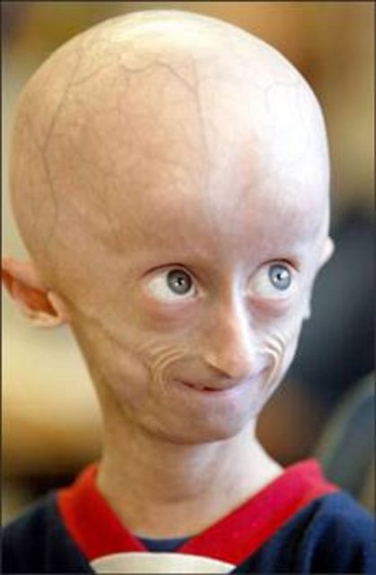Progeria: 80 yaşındaki çocuk sendromu