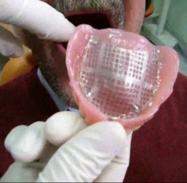 Takma dişler ve ağızdaki yapısal bozukluklar için kullanılan protez damaklar da bakteri yuvasıdır. -  -  -  -