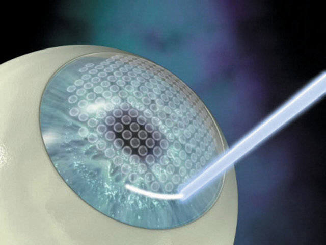 * Argon Lazer: Şeker hastalığına (diyabet) bağlı kanamaları engellemek için uygulanıyor.