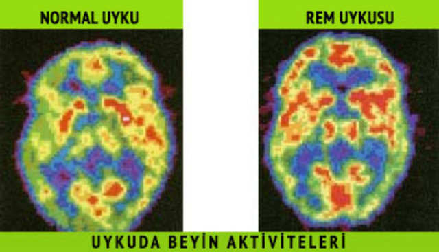 Uykudan uyanmamıza rağmen REM uykusundaki fizyolojik felç hali(göz ve solunum kasları)…