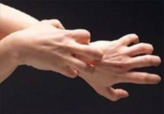 HASTALIĞIN BELİRTİLERİ: Deride pembe kızarıklıklar, ciltte 1 ile 10 cm arası döküntüler, kısa zamanda şişliğe dönen cilt kızarıklıkları.