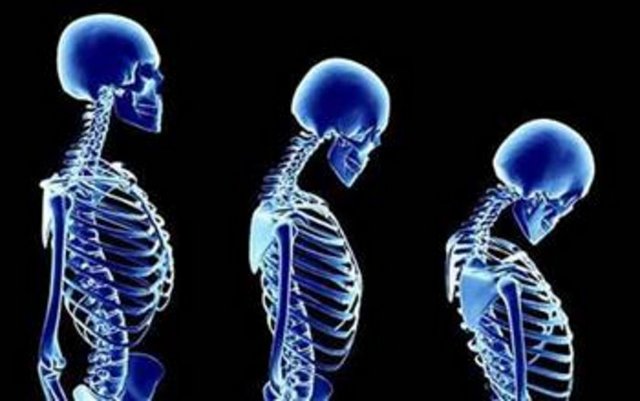 KEMİK ERİMESİ: Düşük kemik yoğunluğuna bağlı olarak kemik direncinin azalması ve kırılma riskinin artması olarak tanımlanan kemik erimesi hastalığı (Osteoporoz) günümüzün en çok görülen kemik hastalıklarından biridir.