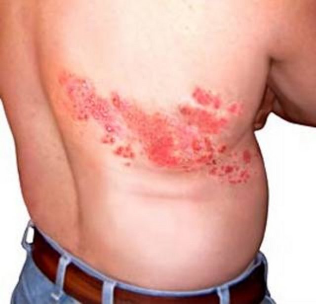 HASTALIĞIN BELİRTİLERİ: Derinin belirli bir bölgesinde yanma batma tarzında ağrı ve duyarlılık artışıdır. Bu ağrı döküntünün gelişmesinden 2-3 gün önce döküntü alanında başlar. Bu arada baş ağrısı ve ateş olabilir. Bu alanda daha sonra kızarıklık ve şeffaf su kabarcıkları gruplar halinde oluşur.