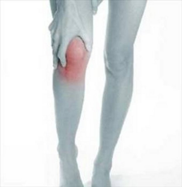 HASTALIĞIN BELİRTİLERİ: Hastalık, kendini, yürümede zorluklar, dizde genel bir ağrı olarak göstermektedir. Ağrı ve şişlik, eklemin hareket açıklığında azalma, diz içinde sıvı birikmesi, dizde sıvı akışı hissi.