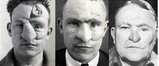 2.William M. Spreckley, Kayıtlara geçen ilk burun operasyonu Plastik cerrahiye öncülük eden kayıtlı operasyonlardan biri de Dr. Harold Gillies'in 1.Dünya Savaşı askeri M.Spreckley'e yapılandı. Spreckley, Ocak 1917'de doktora gelen 132.hastasıydı ve 33 yaşında silahla burnundan yaralanmıştı. Yaklaşık bir buçuk yıl sonra Ekim 1920'de taburcu edildi.