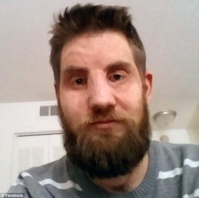 ABD'de geçirdiği bir trafik kazasında yüksek gerilim hattındaki 20 bin volt elektrikle yüzü yok olan amerikalı asker Mitch Hunter (35) 2011'de yüz nakli oldu.  -  