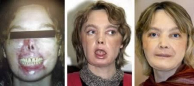 6.Isabelle Dinoire, Bölgesel Yüz Nakli Yapılan İlk İnsan Yüz nakli bir insanın yüzünün tamamen başka bir insanın yüzüne yerleştirildiği tıbbi bir işlemdir. Beyin ölümü gerçekleşmiş bir kadından alınan ağız ve burun hastaya yerleştirildi. Dünyanın ilk yüz nakli 2010 yılında İspanya'da tamamlandı. .
