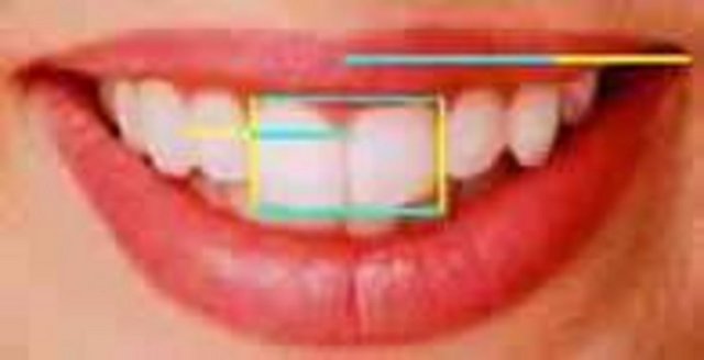 Fotoğrafta ise dişlerin birbirleri arasındaki Altın oranı görmekteyiz. Uzun çizgilerin kısa çizgiye oranı altın orana denk gelmektedir. Bunlar bir dişçinin dikkate alabileceği en ideal oranlardır.