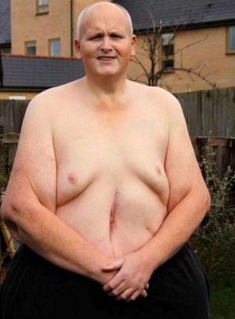 Kilo verdikten sonra sarkan derilerinin yürüyüşünde zorluk çıkardığını söyleyen Mason, ameliyatla onların alınması gerektiğini belirtti