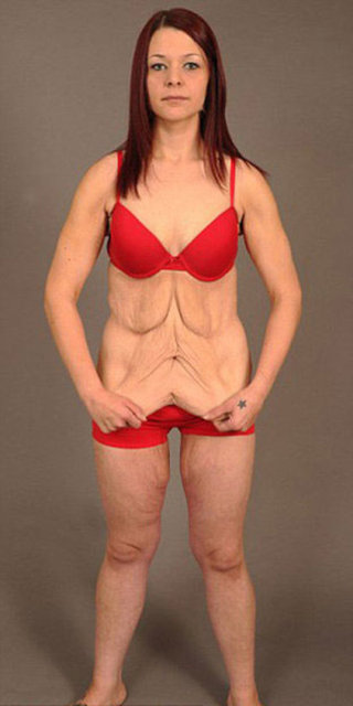 Yeni evli 23 yaşındaki Miles, vücudundaki fazla deri nedeniyle anneanne gibi göründüğünü söylüyor.